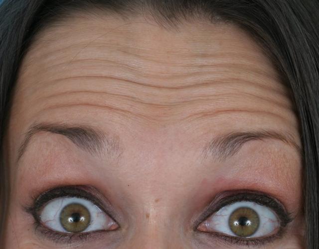 Botox before at Anil Shah, MD, FACS Facial Plastics in Chicago, IL
