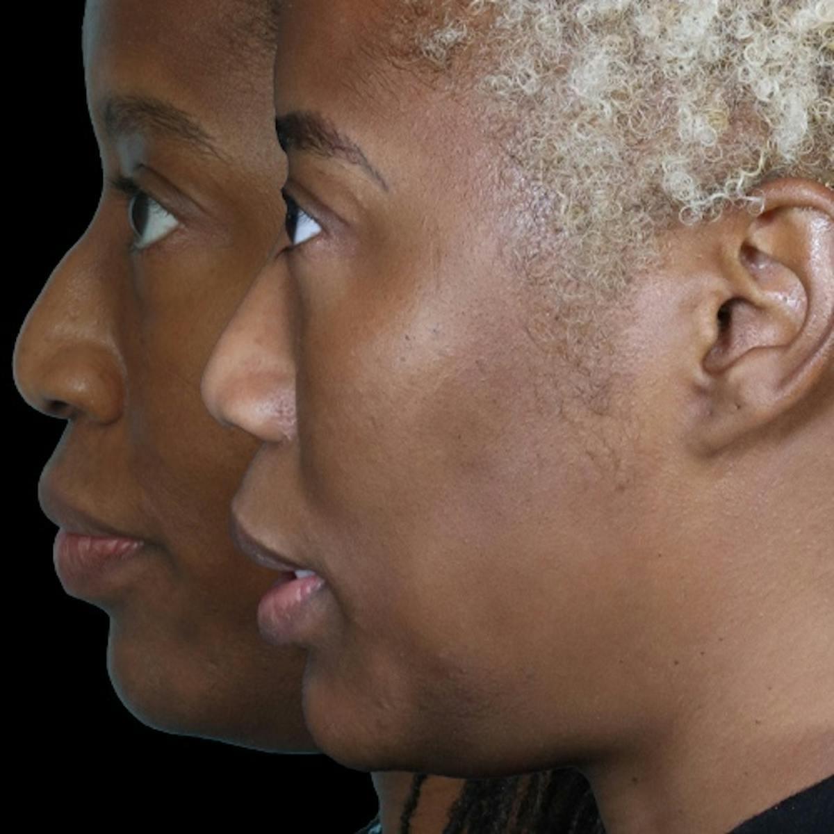 Anil Shah, MD, FACS Facial Plastics rhinoplasty result — Chicago, IL
