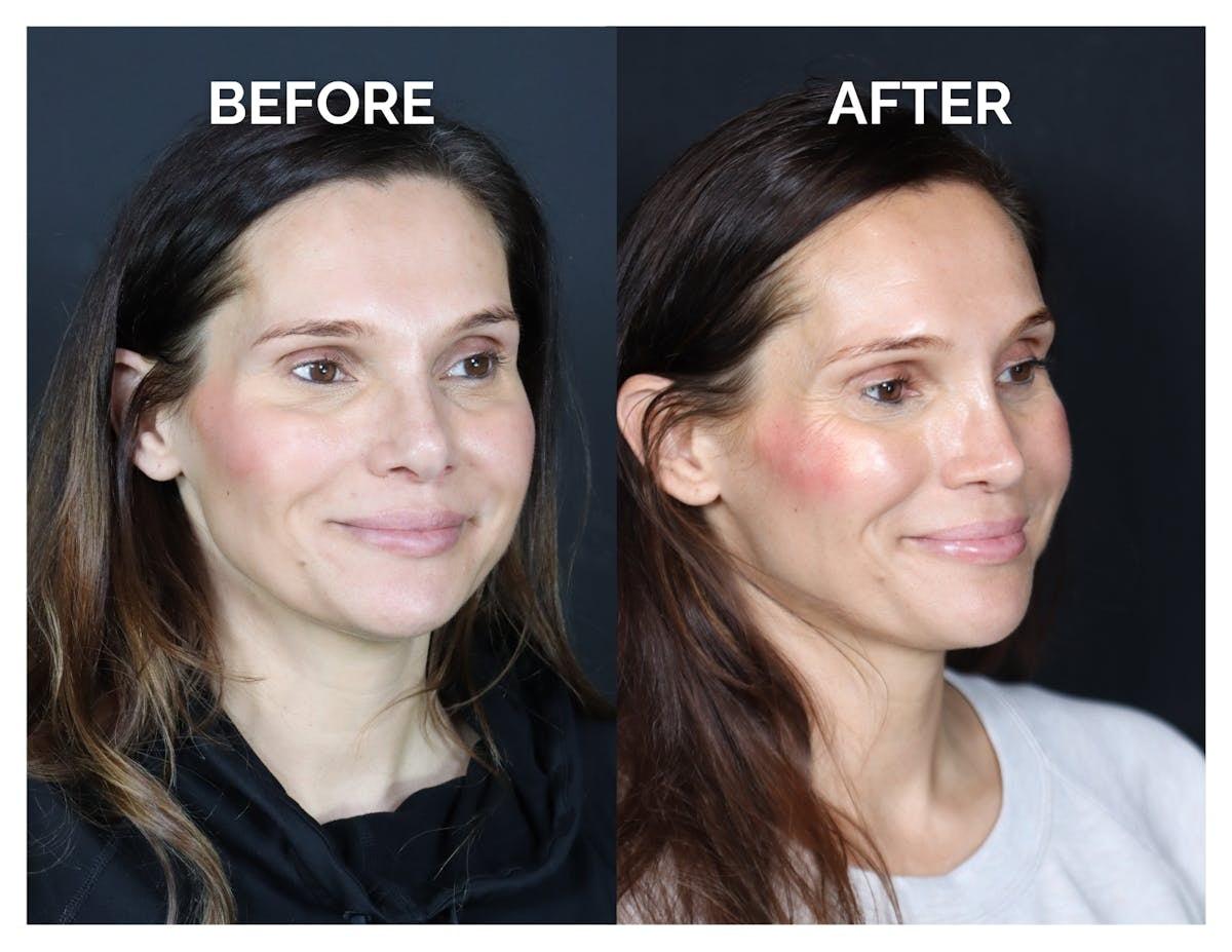 Anil Shah, MD, FACS Facial Plastics rhinoplasty result — Chicago, IL