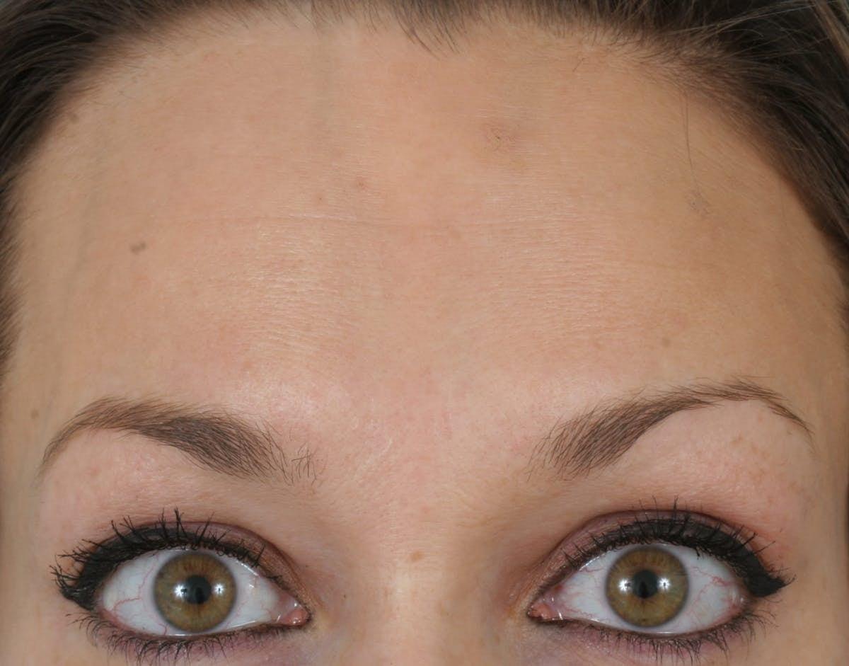Anil Shah, MD, FACS Facial Plastics botox after — Chicago, IL