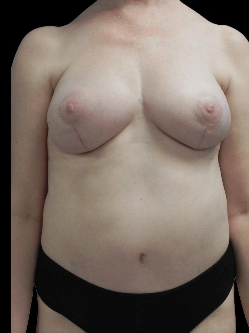 PRMA Plastic Surgery | Center For Advanced Breast Reconstruction after — San Antonio, TX