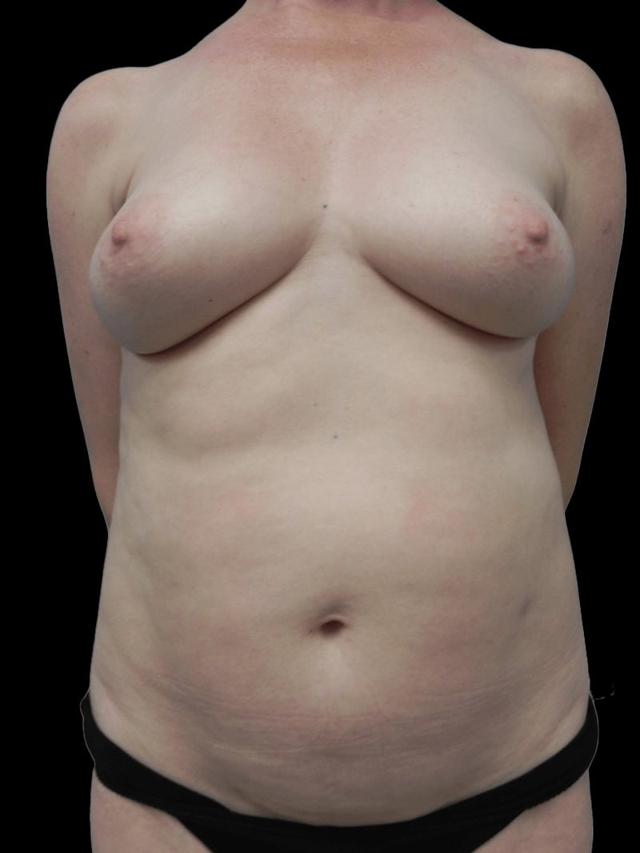 Breast Lift before at PRMA Plastic Surgery | Center For Advanced Breast Reconstruction in San Antonio, TX