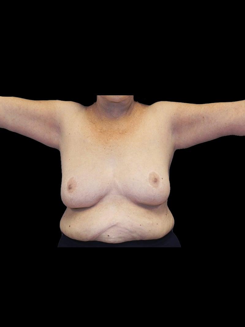 PRMA Plastic Surgery | Center For Advanced Breast Reconstruction arm lift after — San Antonio, TX