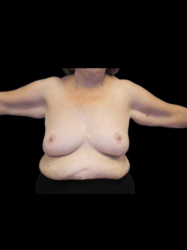 Arm Lift before at PRMA Plastic Surgery | Center For Advanced Breast Reconstruction in San Antonio, TX