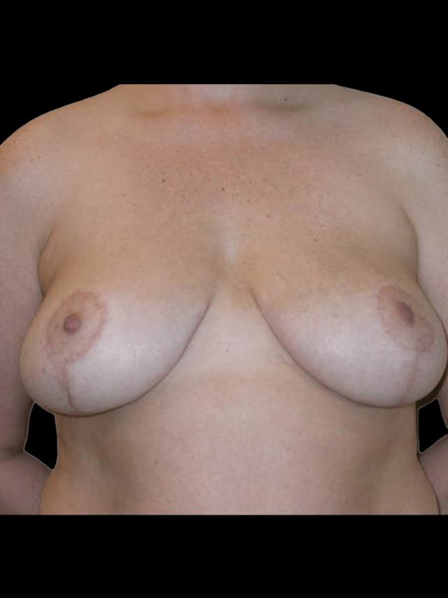 Breast Reduction after at PRMA Plastic Surgery | Center For Advanced Breast Reconstruction in San Antonio, TX
