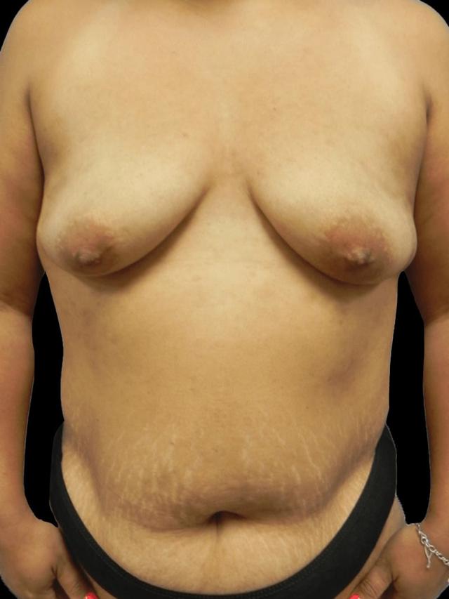 Mommy Makeover before at PRMA Plastic Surgery | Center For Advanced Breast Reconstruction in San Antonio, TX