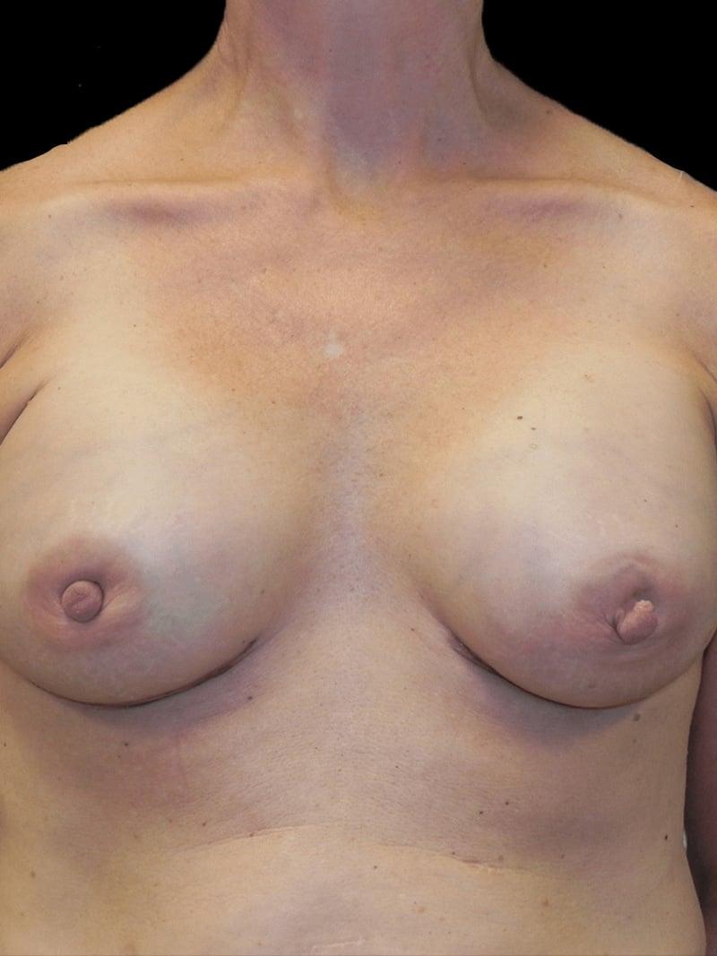 PRMA Plastic Surgery | Center For Advanced Breast Reconstruction breast augmentation after — San Antonio, TX