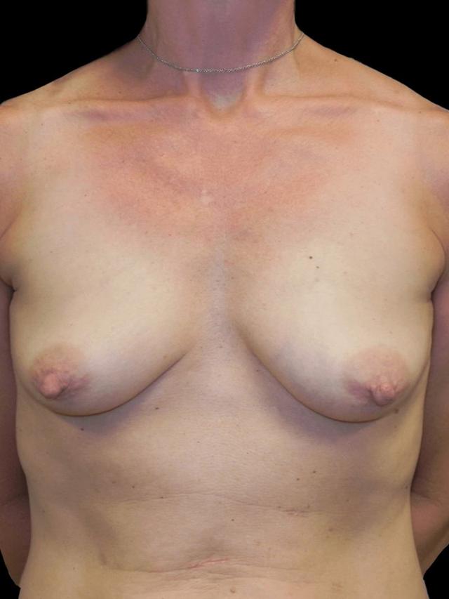 Breast Lift before at PRMA Plastic Surgery | Center For Advanced Breast Reconstruction in San Antonio, TX