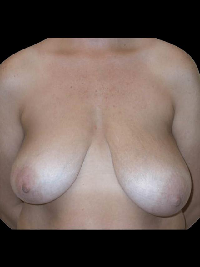 Breast Reduction before at PRMA Plastic Surgery | Center For Advanced Breast Reconstruction in San Antonio, TX