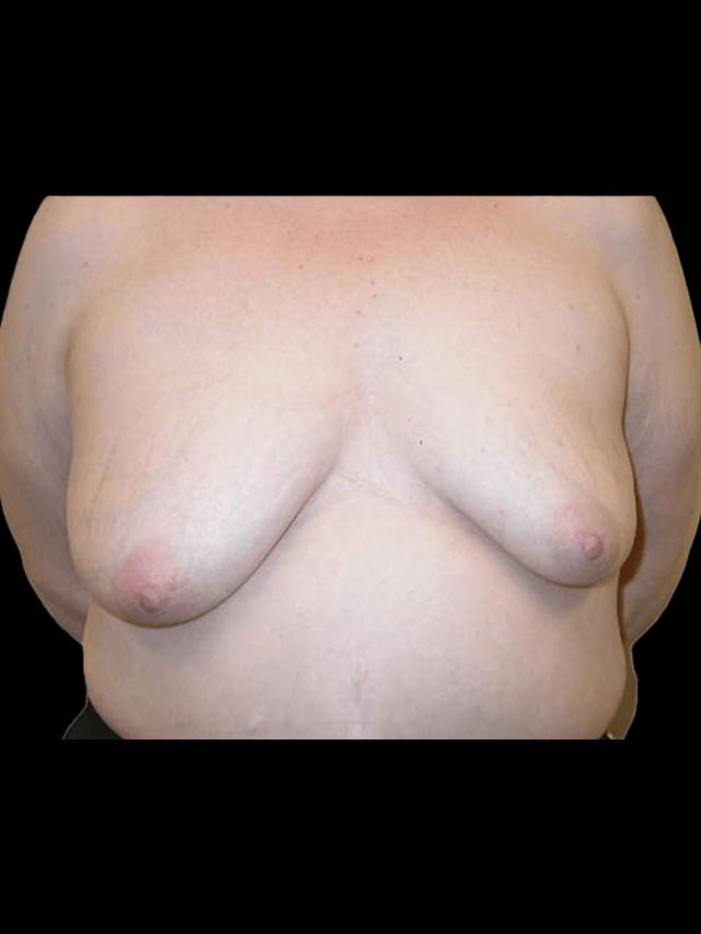 Breast Lift before at PRMA Plastic Surgery | Center For Advanced Breast Reconstruction in San Antonio, TX
