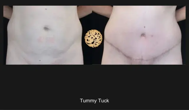 Tummy Tuck result at Nazarian Plastic Surgery in Beverly Hills, CA