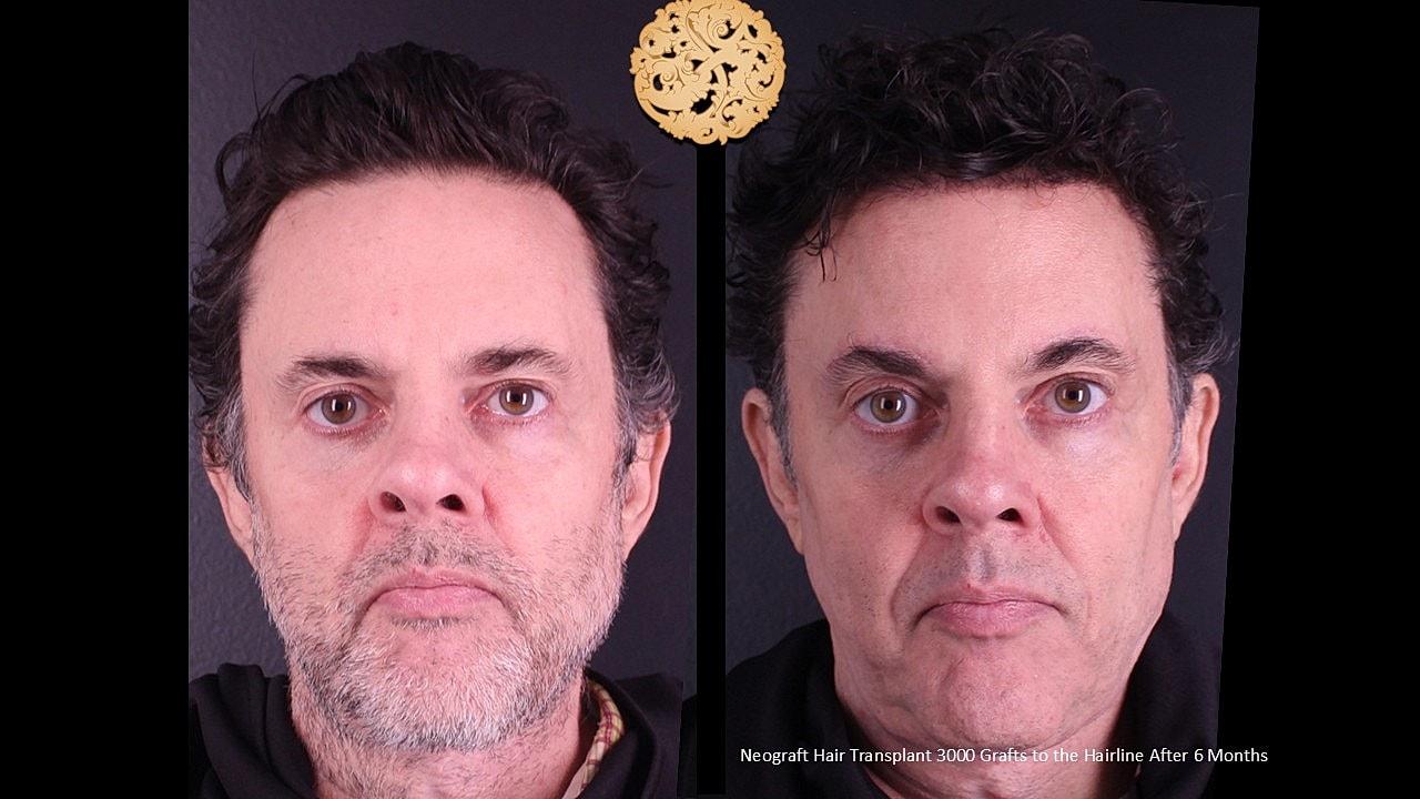 Nazarian Plastic Surgery hair restoration result — Beverly Hills, CA