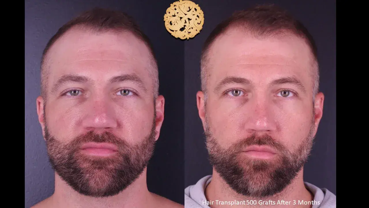 Nazarian Plastic Surgery hair restoration result — Beverly Hills, CA