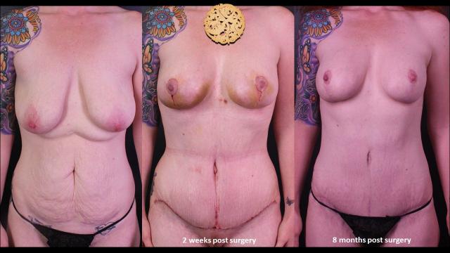 Mommy Makeover result at Nazarian Plastic Surgery in Beverly Hills, CA