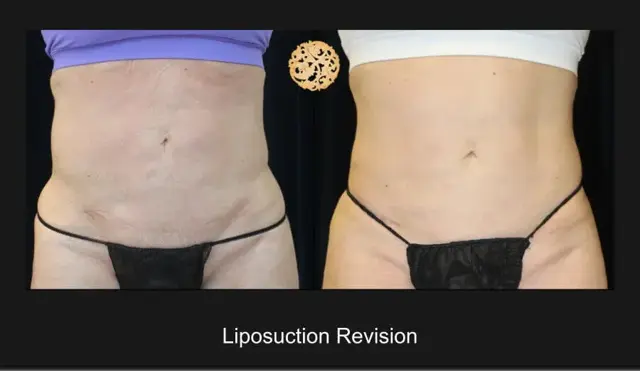 Liposuction result at Nazarian Plastic Surgery in Beverly Hills, CA