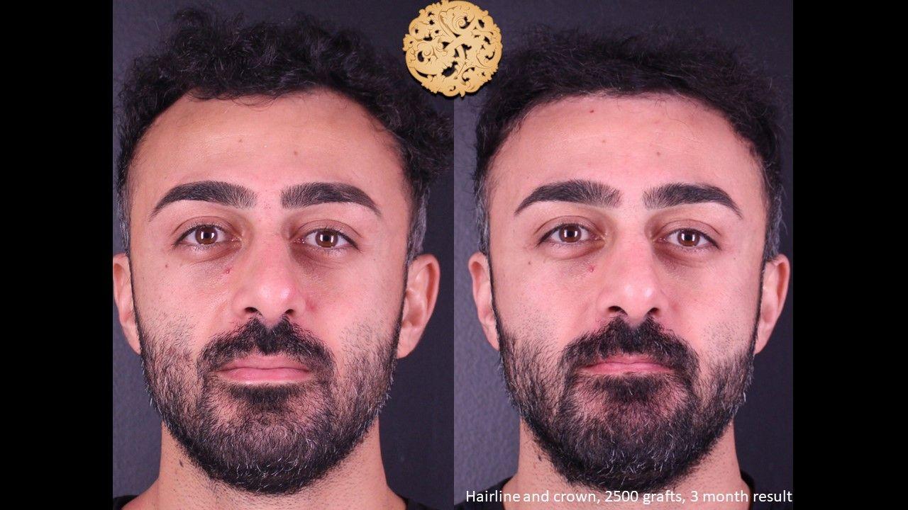 Nazarian Plastic Surgery hair restoration result — Beverly Hills, CA