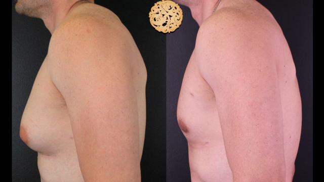 Gynecomastia Surgery result at Nazarian Plastic Surgery in Beverly Hills, CA