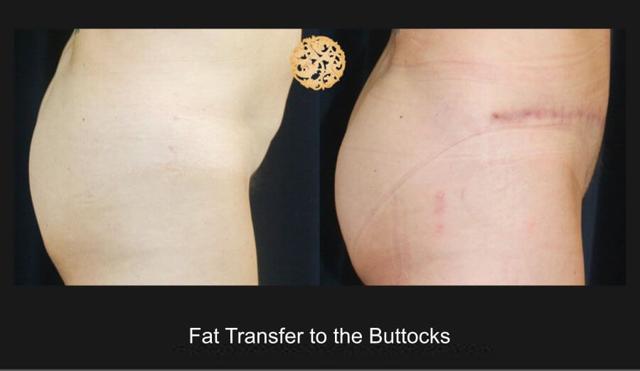 Brazilian Butt Lift result at Nazarian Plastic Surgery in Beverly Hills, CA