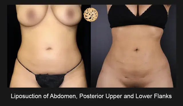 Liposuction result at Nazarian Plastic Surgery in Beverly Hills, CA