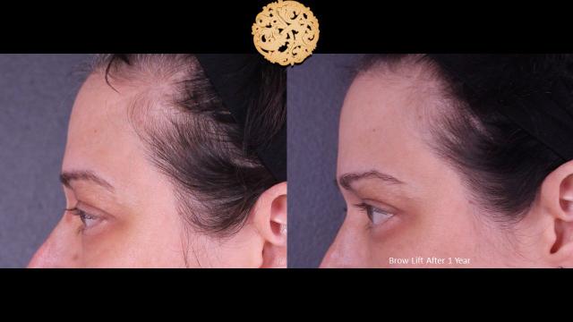 Brow Lift result at Nazarian Plastic Surgery in Beverly Hills, CA