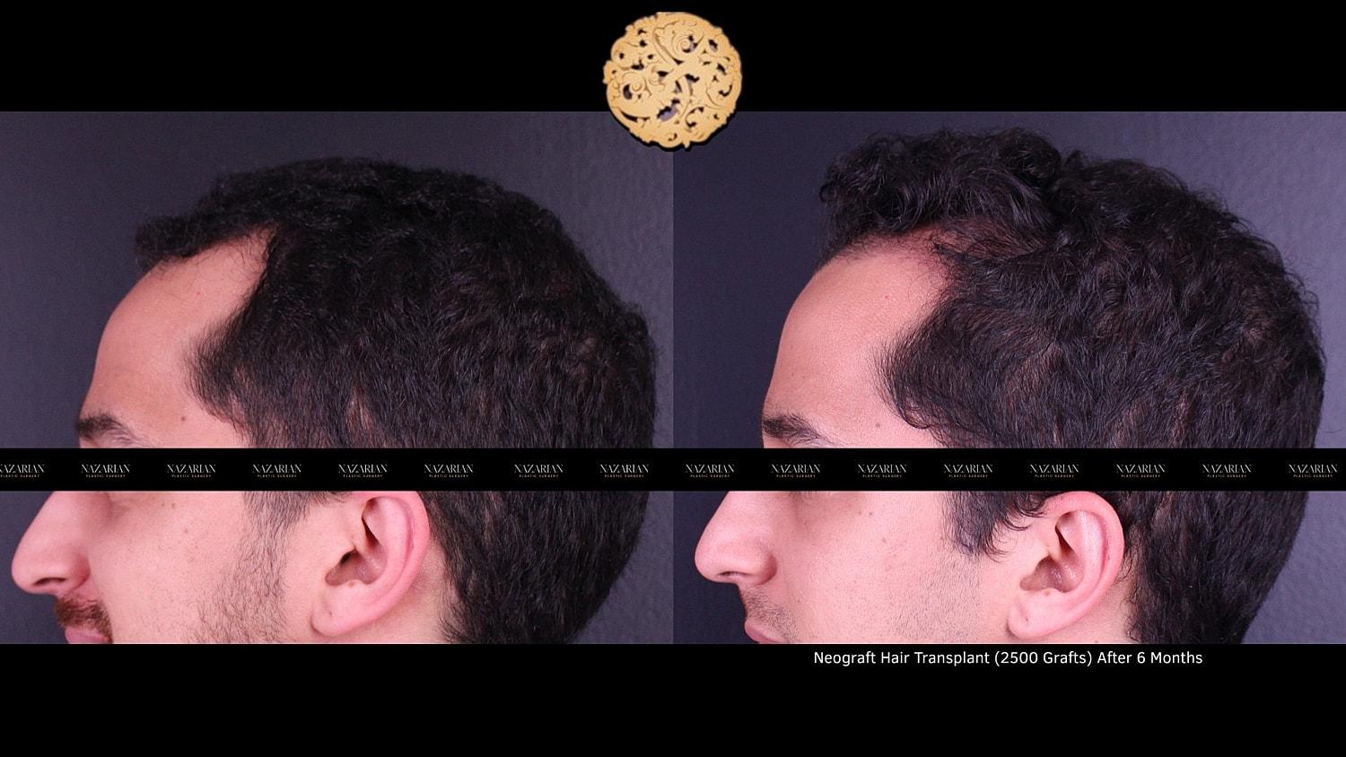 Nazarian Plastic Surgery hair restoration result — Beverly Hills, CA