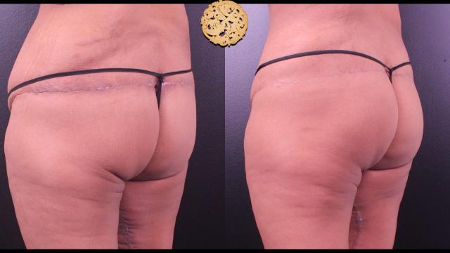 Brazilian Butt Lift result at Nazarian Plastic Surgery in Beverly Hills, CA