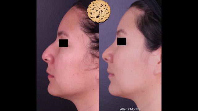 Rhinoplasty result at Nazarian Plastic Surgery in Beverly Hills, CA