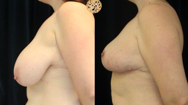 Breast Reduction result at Nazarian Plastic Surgery in Beverly Hills, CA