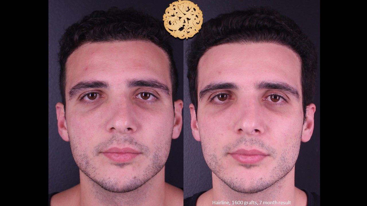 Nazarian Plastic Surgery hair restoration result — Beverly Hills, CA