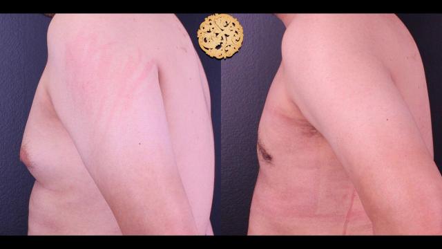 Gynecomastia Surgery result at Nazarian Plastic Surgery in Beverly Hills, CA
