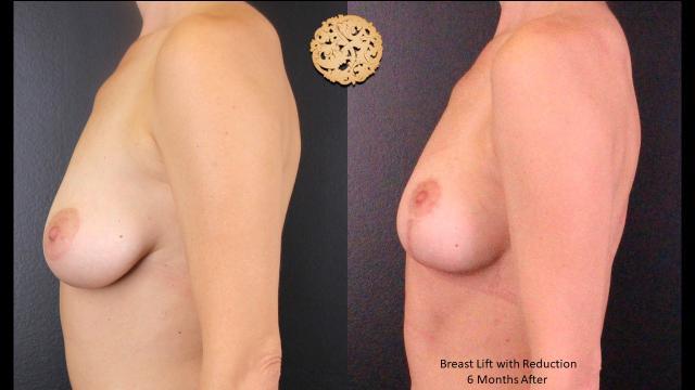 Breast Reduction result at Nazarian Plastic Surgery in Beverly Hills, CA