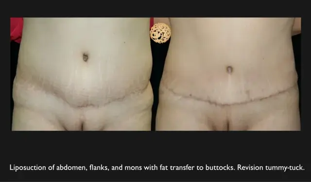 Tummy Tuck result at Nazarian Plastic Surgery in Beverly Hills, CA