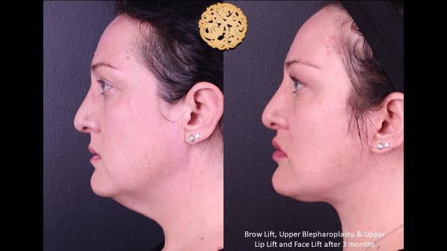 Brow Lift result at Nazarian Plastic Surgery in Beverly Hills, CA