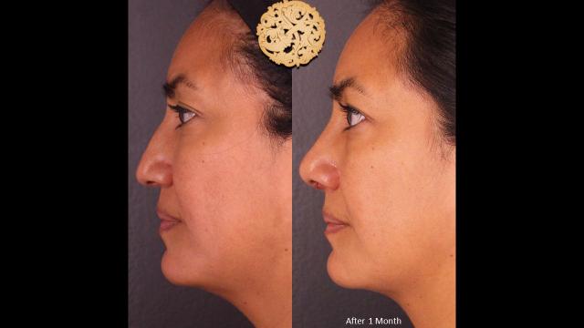 Rhinoplasty result at Nazarian Plastic Surgery in Beverly Hills, CA