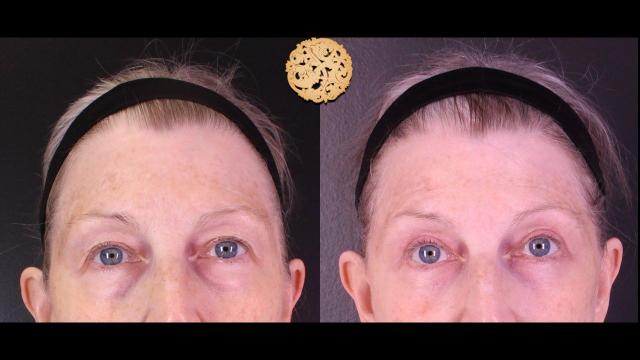 Blepharoplasty result at Nazarian Plastic Surgery in Beverly Hills, CA