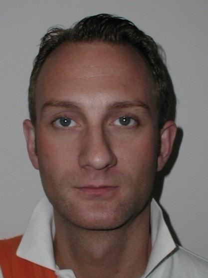 Chin Implant after at Mossi Salibian, MD in Los Angeles, CA