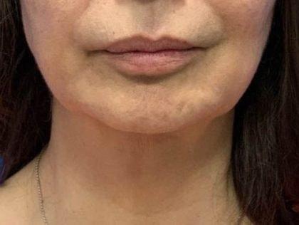 Neck Liposuction after at Mossi Salibian, MD in Los Angeles, CA