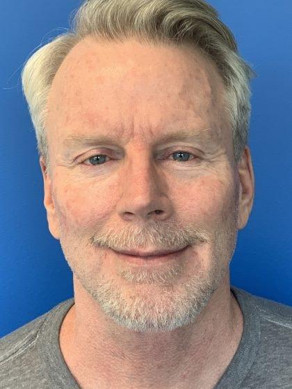 Chin Implant after at Mossi Salibian, MD in Los Angeles, CA