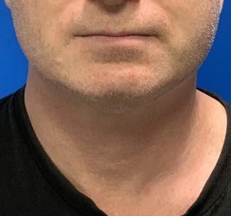 Neck Liposuction after at Mossi Salibian, MD in Los Angeles, CA