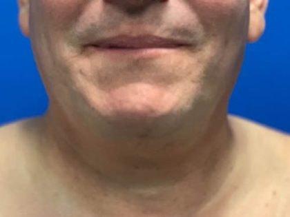 Neck Liposuction before at Mossi Salibian, MD in Los Angeles, CA