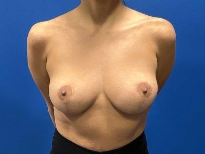 Mossi Salibian, MD breast implant removal after — Los Angeles, CA