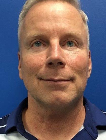 Chin Implant before at Mossi Salibian, MD in Los Angeles, CA