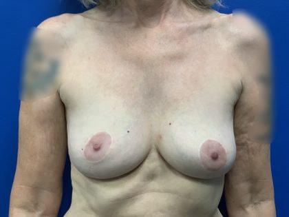 Mossi Salibian, MD breast implant removal after — Los Angeles, CA