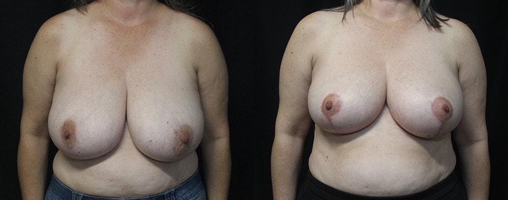 Lynn Chung, MD breast reduction result — Puyallup, WA