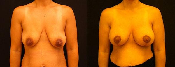 Lynn Chung, MD breast augmentation result — Puyallup, WA