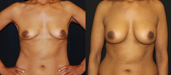 Lynn Chung, MD breast augmentation result — Puyallup, WA