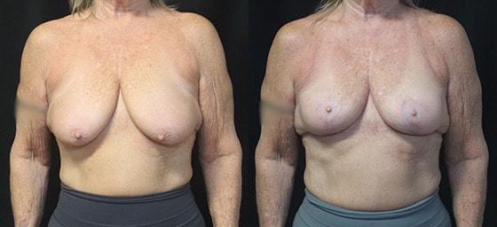 Lynn Chung, MD breast lift result — Puyallup, WA
