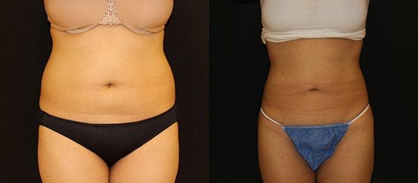 Lynn Chung, MD liposuction result — Puyallup, WA