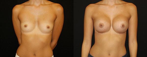 Lynn Chung, MD breast augmentation result — Puyallup, WA