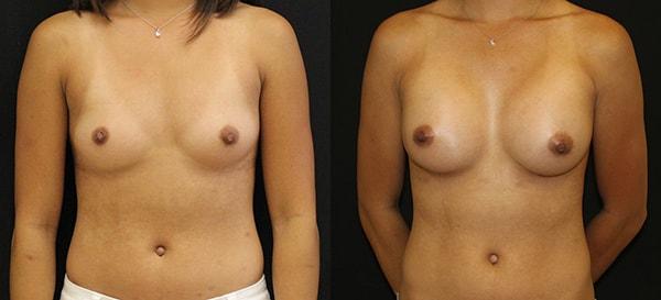 Lynn Chung, MD breast augmentation result — Puyallup, WA